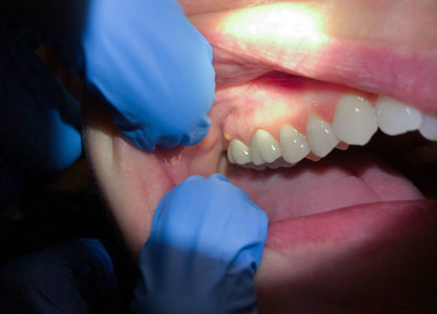Best Emergency Dentist for Knocked-Out Tooth in Five Corners, WA